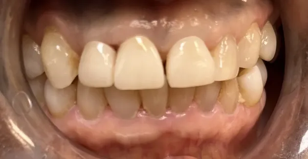 Image of teeth after getting dental crowns