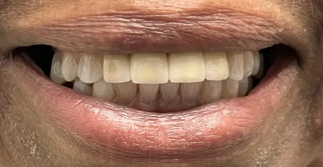 After image of the mouth after dental implants