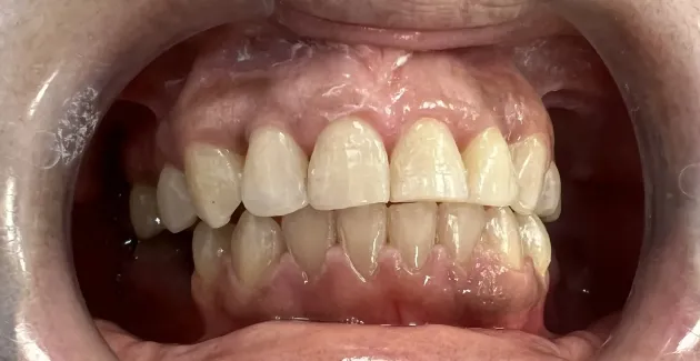 Picture of teeth and mouth after braces