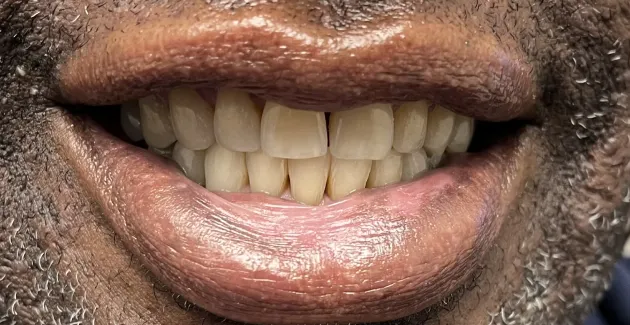 Picture after using Invisalign