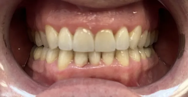 Picture after using Invisalign