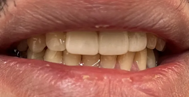 Image of teeth after getting dental crowns