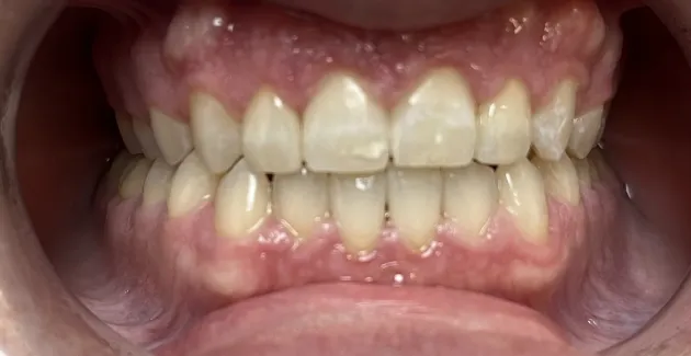 Picture after using Invisalign