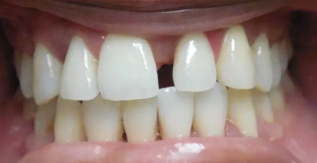 Before image of mouth before dental implants