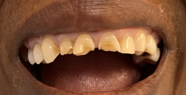 Image of teeth before getting dental crowns