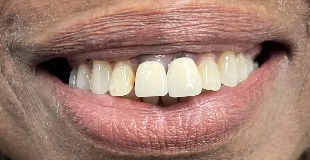 Before image of mouth before dental implants