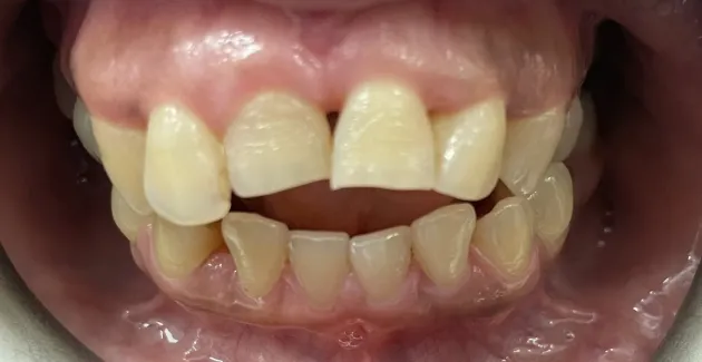 Picture of teeth and mouth before braces