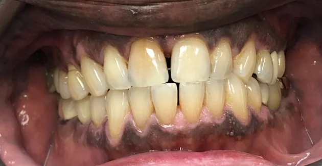 Picture before Invisalign