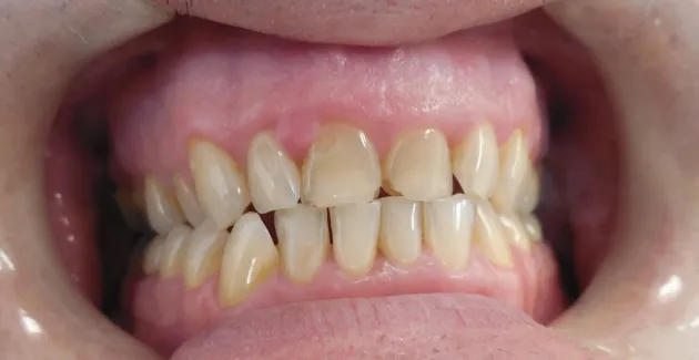 Picture before Invisalign