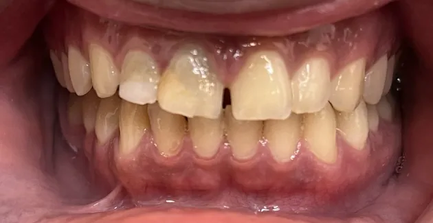 Image of teeth before getting dental crowns