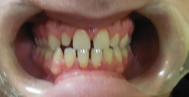 Picture before Invisalign