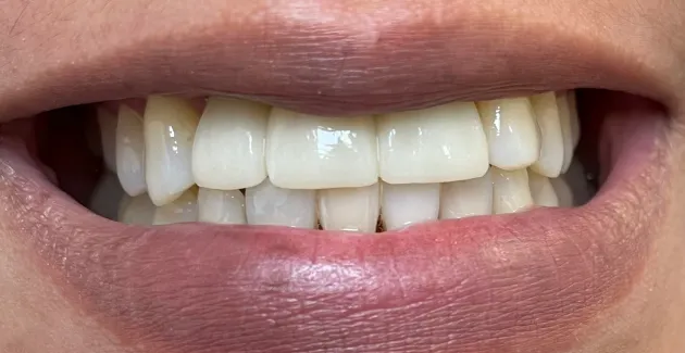 After image of the mouth after dental implants