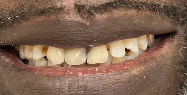 Before Crown